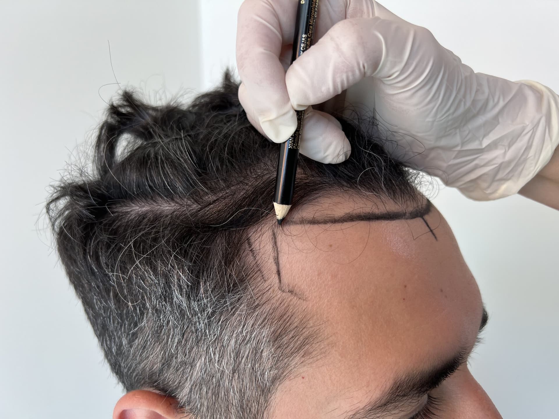 Diagnóstico de tricoscopía para pelo delgado en Capilness