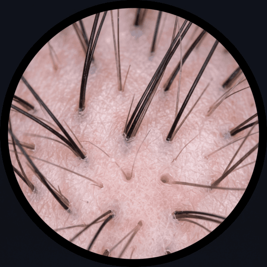 Detalle dermatoscópico del folículo en tricoscopía